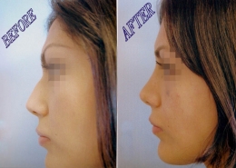 Nose Sculpting Surgery