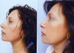 Nose Sculpting Surgery