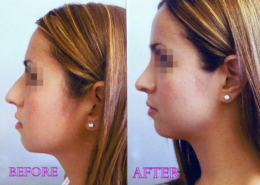 Nose Sculpting Surgery