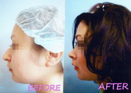 Nose Sculpting Surgery