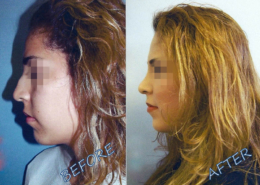 Nose Sculpting Surgery