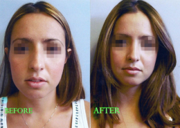 Nose Sculpting Surgery