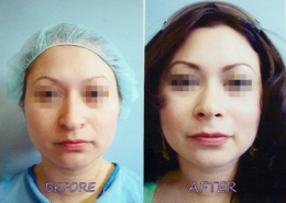Nose Sculpting Surgery