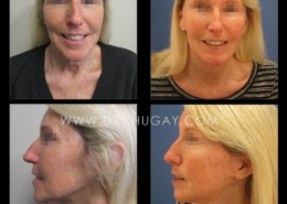 58yo female before and 4 months after face and neck lift
