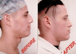 Nose Sculpting Surgery