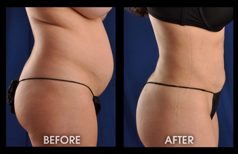 Liposuction Los Angeles, Liposculpture