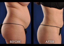 Precision Liposculpture