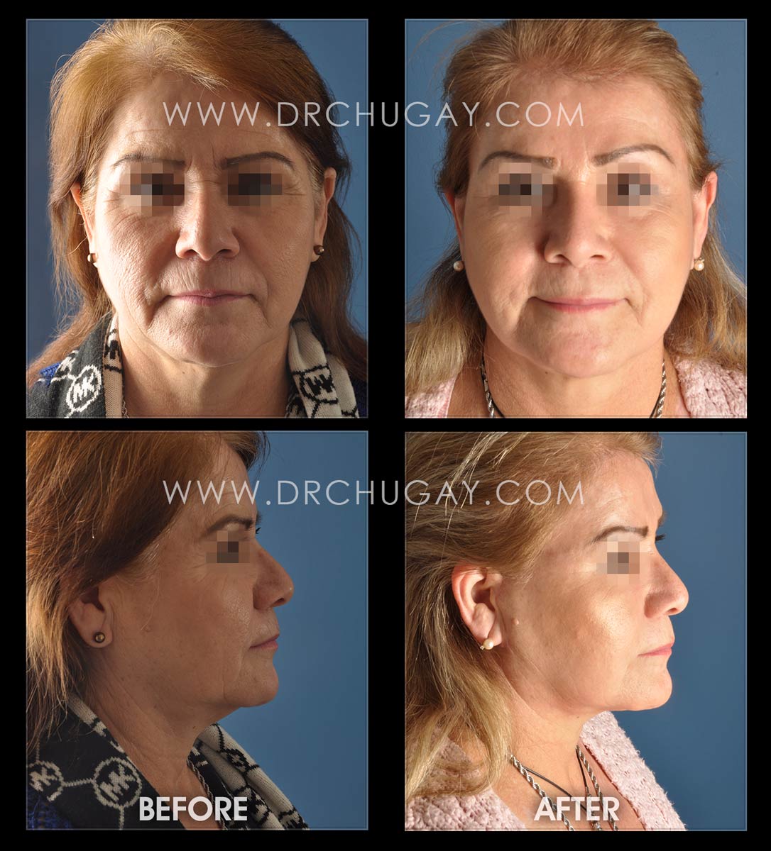 64yo before and 8 months after face and neck lift.