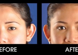 Eyelid Surgery