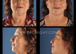 70yo female before and 6 months after face and neck lift.