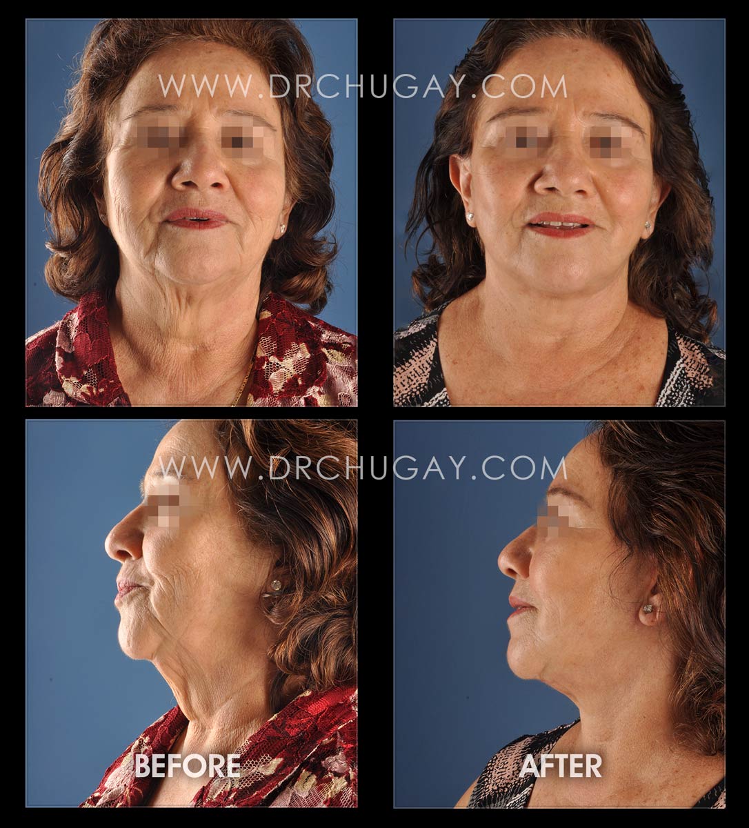 70yo female before and 6 months after face and neck lift.