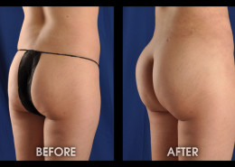 Buttock Augmentation