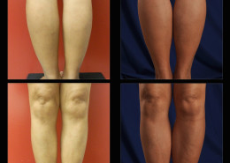 Calf Implants