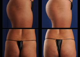 BUTTOCK AUGMENTATION WITH IMPLANTS