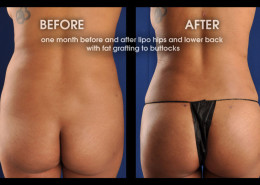 Buttock Augmentation