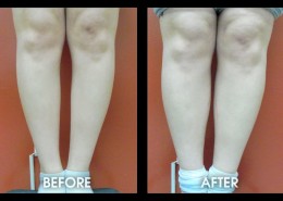Calf Implants