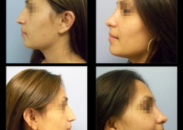 Nose Sculpting Surgery