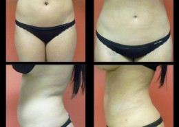Liposuction