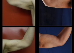 Bicep Implants