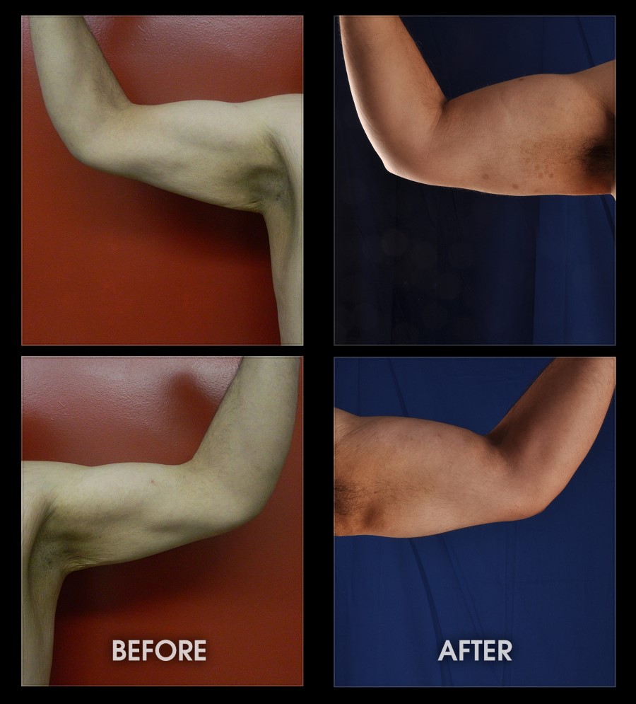 Biceps And Triceps Implants Photos, New York, NY