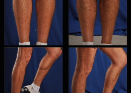 Calf Implants