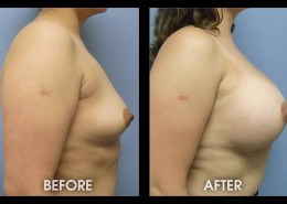 Breast Augmentation