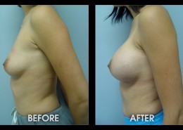 Breast Implants