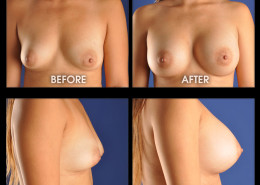 Breast Augmentation