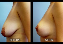 Breast Lift With Augmentation