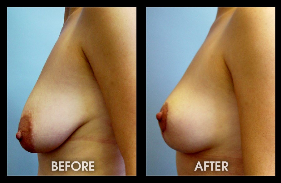 Breast Lift With Augmentation
