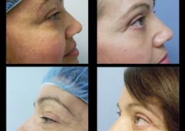Eyelid Surgery