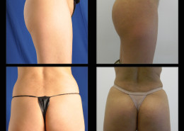 Buttock Augmentation | Implants