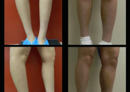 Calf Implants