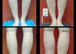 Calf Implants
