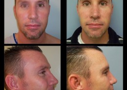 Crows Feet Surgery Before After Photos