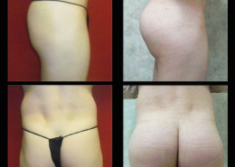 Buttock Augmentation
