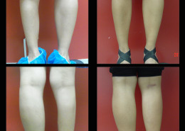 Calf Implants