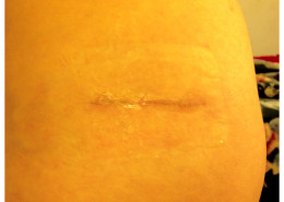Incision