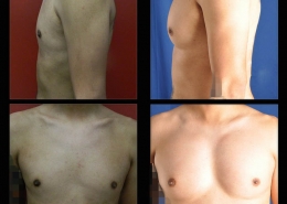 Pectoral Implants