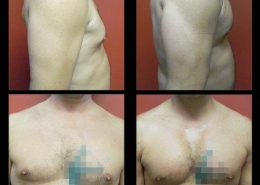 Pectoral Implants