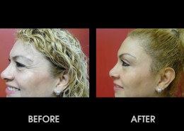 Crows Feet Surgery Before After Photos Feet