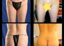 Hip / Thigh Augmentation