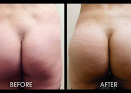 Buttock Augmentation