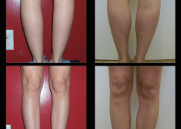 Calf Implants
