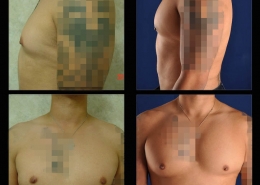 Pectoral Implants