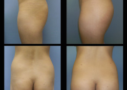 Buttock Augmentation