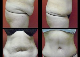 Tummy Tuck