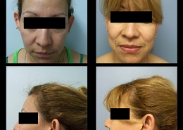 Ear Contouring Surgery