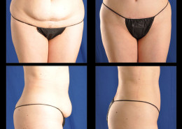 Tummy Tuck