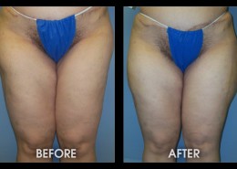 Hip / Thigh Augmentation